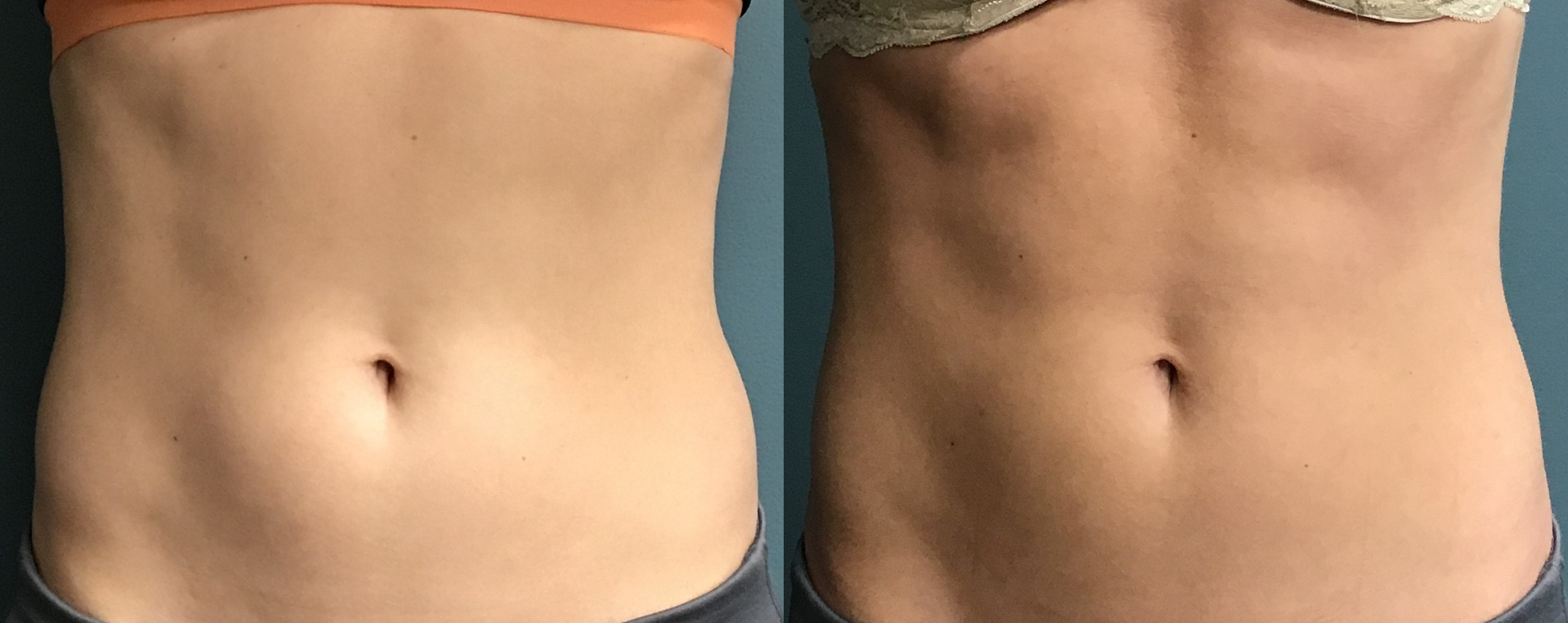 abs